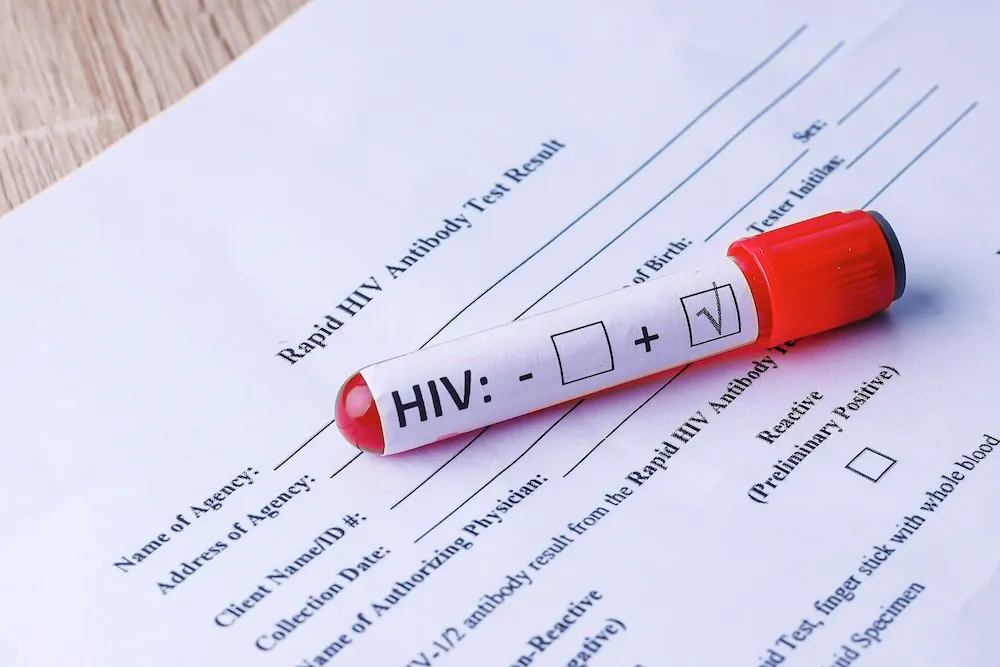 A test tube labeled 'HIV:' lying on a medical test result form indicating the HIV antibody test result.